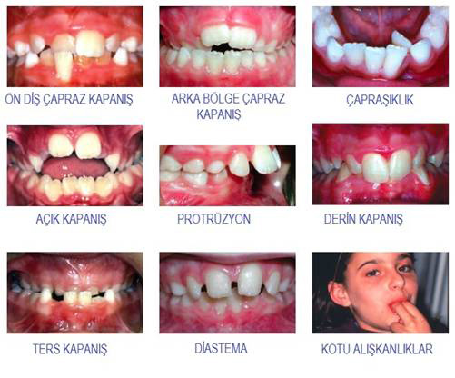 Çocuklarda Sk Görülen Ortodontik Problemler