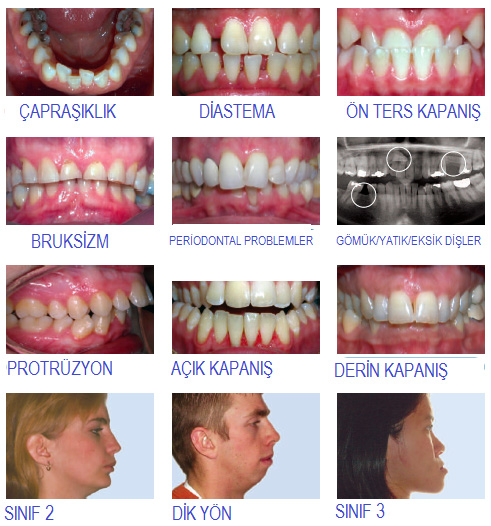 Erişkinlerde Sık Görülen Ortodontik Problemler