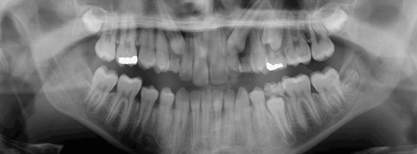 Gömük Dişler ve Ortodonti