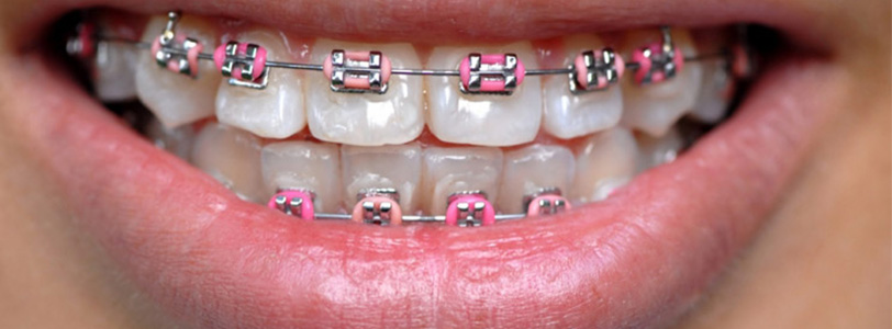 Ortodontik Tedavide Diş Çekimi