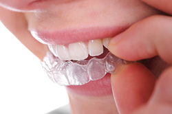ortodontik tedaviler