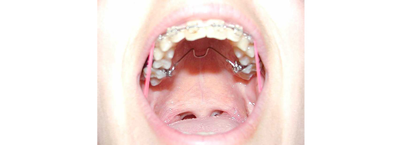 Özel Ortodontik Apareyler TPA