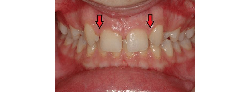 Üst Kesici Diş Eksikliğinde Ortodontik Tedavi